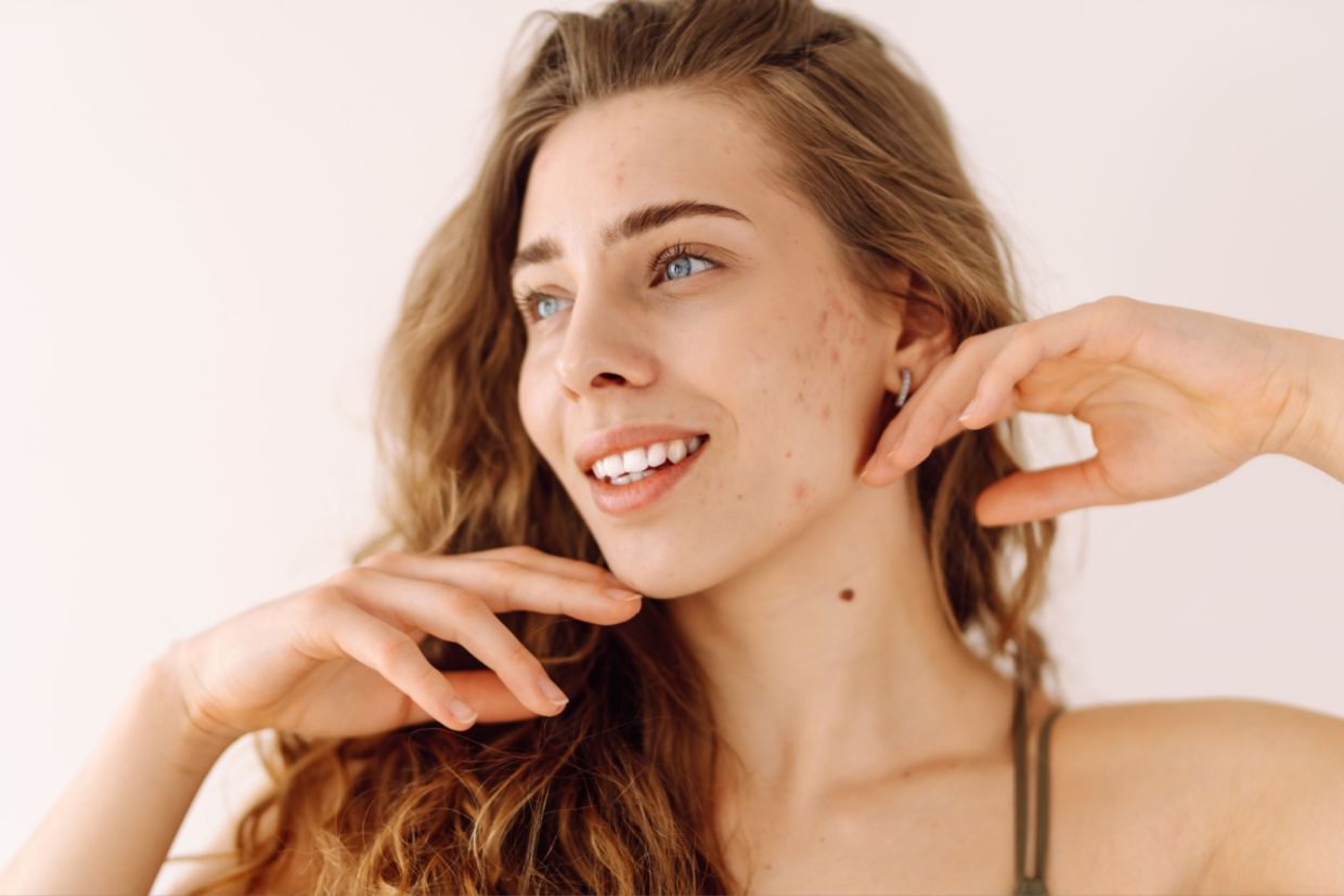 A woman with no makeup and red spots on her face.